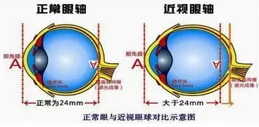 近視眼球突出？！控制近視度數(shù)加深是關(guān)鍵！