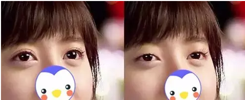 要不要做雙眼皮？別糾結了看這個！