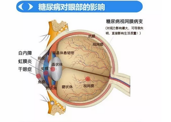 你造嗎？糖尿病晚期眼睛會(huì)致盲！