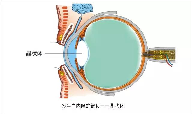 眼科主任告誡白內(nèi)障這幾大誤區(qū)，80%的老人上當