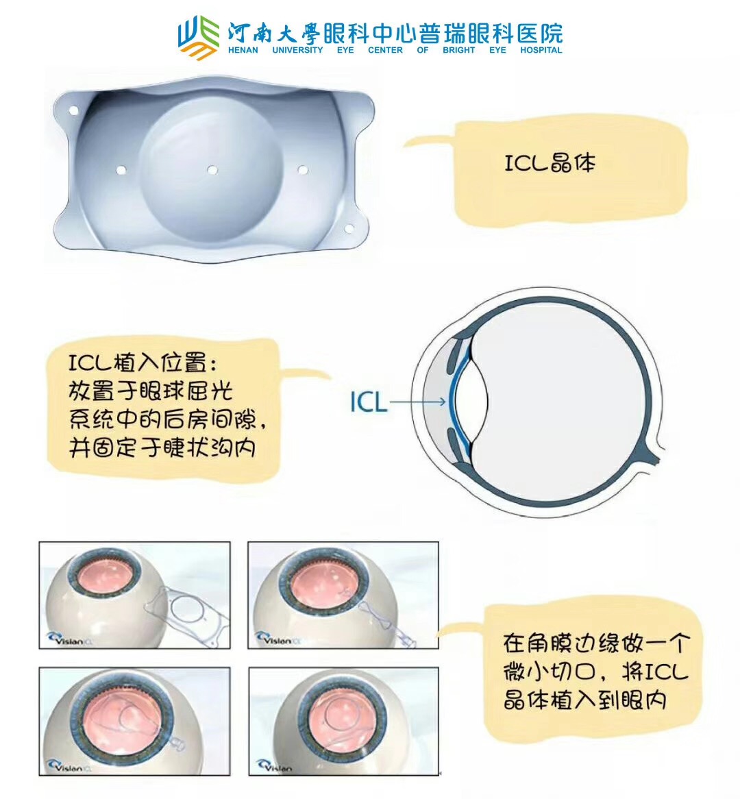 近視度數太高，還能做手術嗎？